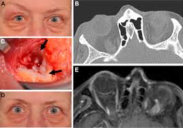 Image result for Dacryoadenitis