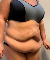 Search for pictures tummy tuck at sprask. Patient 4058 Tummy Tuck Before And After Photos Calhoun Ga Plastic Surgery Gallery Chattanooga Tn Southern Surgical Arts