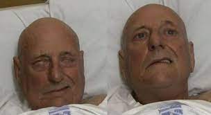 They include the vulnerable people, the elderly individuals with underlying. Progressive Bilateral Facial Weakness Practical Neurology