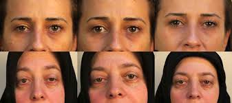 An Alternative Algorithm for Müller Muscle Conjunctival Resection Surgery  for Blepharoptosis Management