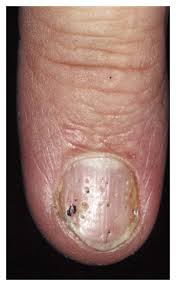 Image result for Pitting nails feet