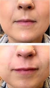Stock orders that may take longer to fill. Dermal Fillers Solace Wellness Center Medspa Tewksbury Ma