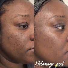 Image result for Melasma