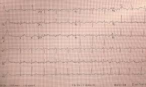 Girl Who Cried Wolf: A Case of Prinzmetal Angina With Related ST-Elevation  Myocardial Infarction