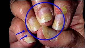 Placas hiperqueratósicas discretas nas palmas das mãos e/ou plantas dos pés que tendem a se tornar confluentes. Os 5 Tratamentos Naturais Para Psoriase Nas Unhas Dicas De Saude