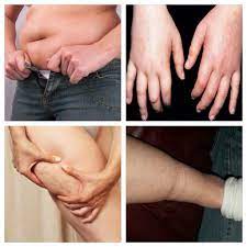 If You Have Water Retention Issues I Can Help That And Much More Hands Tight And Swollen Rings Won T F Bloated Belly Water Retention How To Stay Healthy