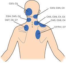 Cervical Facet Syndrome Anesthesia Key