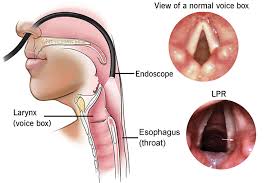 Ung thư hạ họng là tình trạng khối u xuất hiện ở vùng hạ họng thuộc biểu mô đường tiêu hóa, sau đó lan nhanh vào thanh quản. Há»™i Chá»©ng Trao NgÆ°á»£c Há»ng Thanh Quáº£n La Gi Co Nguy Hiá»ƒm Khong