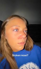 DWTS' Troupe Dancer Hailey Bills Reveals Possible Broken Nose After  Thanksgiving Game Gone Wrong