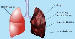Early symptoms of lung cancer are hard to notice because there's rarely pain or discomfort. Prevent Lung Cancer Causes And Risk Factors