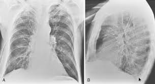 Computed tomography scan of the chest demonstrates loculated pleural effusion in the left major fissure (arrow) in a patient after coronary bypass. The Pleura Radiology Key