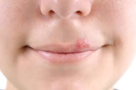 What is herpes simplex virus? Flushing Hospital Wants You To Know About Cold Sores Health Beat