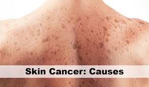 What causes it and who is at risk? Skin Cancer Causes First Health Station
