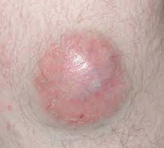 Image result for Merkel Cell Carcinoma