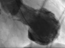 Pourquoi ce nom de syndrome du coeur brisé ? Le Syndrome Du Coeur Brise Sous La Loupe De Chercheurs Zurichois Rtn Votre Radio Regionale