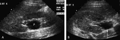Extrarenal Pelvis Stimulating Hydronephrosis Or Cyst To Untrained Eye Ultrasound Sonography Sonography Ultrasound