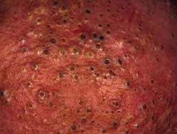 Mild forms may resemble teenage acne. Chloracne Madish Dermnet Nz