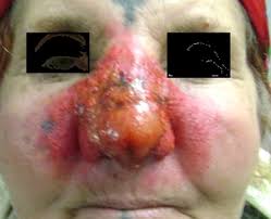 Image result for Erysipeloid