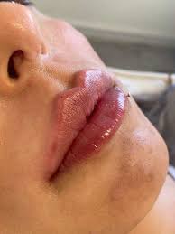 Lippen aufspritzen mit Hyaluronsäure Filler | Volle Lippen
