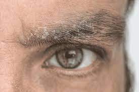 The most common skin diseases that lead to hair loss are dermatitis and psoriasis. How To Identify And Prevent Eyebrow Hair Loss Hair Sure