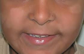 Pityriasis alba is usually asymptomatic in nature. Pityriasis Alba Deximed