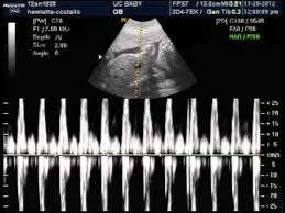 Baby Boys Heart Beat 25 Weeks 3d Ultrasound Nov 20 2012