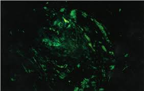 The dyeing of amyloid is by a mechanism similar to the direct textile dyeing of cotton. Amyloid Demonstrating Apple Green Birefringence With Polarized Light Download Scientific Diagram