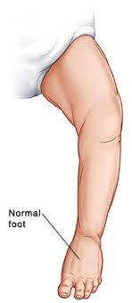 Clubfoot is a common birth defect. When Your Child Has Clubfoot