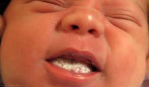 What S That White Stuff Coating The Inside Of Your Baby S Mouth It Might Be Oral Candidiasis Better Known As Thrush Oral Patologia