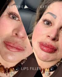 ☑️ LIPS FILLER 👄💉 📍 Tijuana B.C