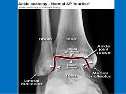 Presentation1 Pptx Ankle Joint