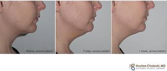 Kybella double chin before and after. Recovery After Kybella Treatment Of Neck Fat