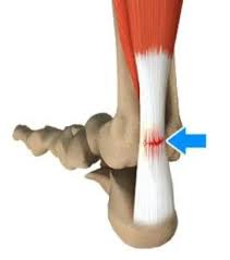 Maybe you would like to learn more about one of these? Achilles Tendon Rupture Dr Ben Beamond Orthopaedic Surgeon Adelaide