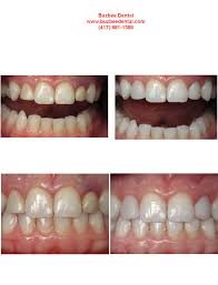 This Patient Had Previous Tooth Colored Fillings Done To Make Her Laterals Teeth Next To The Front Tee Tooth Colored Fillings Before And After Pictures Shapes
