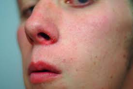 Zelenyashij Streptokokk V Nosu Recept Poshagovyj S Foto