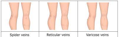 Can You Sleep In Compression Socks Full Answer