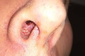 Check spelling or type a new query. What Are These Yellow Liquid Filled Bumps Inside My Nose They Don T Hurt My Nose Is Also A Bit Runny But Not Sure If This Has Anything To Do With It Medical