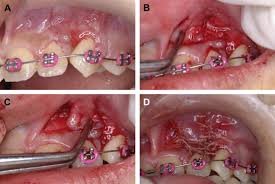 The postoperative recovery was longer after open eruption than close eruption technique (p = 0.000). Surgical Considerations And Management Of Bilateral Labially Impacted Canines Sciencedirect
