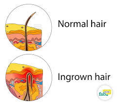 ingrown hair quickly without laser