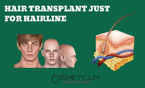 Poorly performed hair transplants, just as with a number of aesthetic practices, are those that every man and woman has a different hair density, hair caliber, hair color, hair curl, hairline, etc. Hair Transplant Just For Hairline Everything You Need To Know