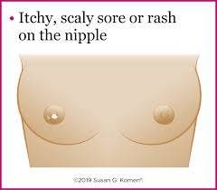 Breast cancer causes, symptoms & signs. Warning Signs Of Breast Cancer Do You Know What To Watch For