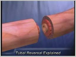 On peut aussi faire de ligature des trompes lors d'une césarienne. Chirurgie Inversee De Ligature Des Trompes Inde Avantages A Faible Cout