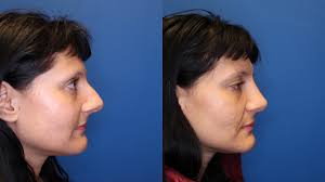However, aesthetic rhinoplasty is rarely covered. Nose Job Rhinoplasty For Northern California Kaiser Permanente Cosmetic Services