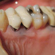 Amalgam tattoo is a fairly common benign pigmented your doctor can usually make the diagnosis of an amalgam condition of the mouth. Presentation Of Amalgam Tattoo On Palatinal Mucosa Of Maxillary Download Scientific Diagram