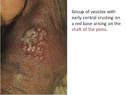 Buy only the ones that suit you best or buy all package for better price. Genital Herpes Infection Ppt Video Online Download