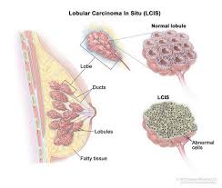 And some people can inherit faults in particular genes that make them more likely to develop a cancer. Breast Cancer Medlineplus Genetics