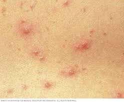 Has your child developed chicken pox? Cara Hilangkan Parut Chicken Pox Dengan Cepat Dan Berkesan Pendankertasdotcom