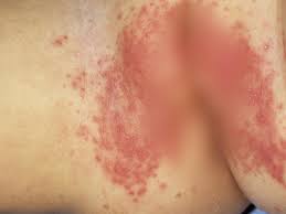 They are flat to the touch and can sometimes look like a rash. Pictures Of Childhood Rashes And Skin Condition Babycenter