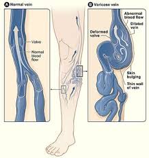 Image result for Tropical Edema