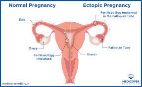 However, ectopic pregnancy can be hard to diagnose since many signs — including breast tenderness, nausea and fatigue — are similar to normal early pregnancy symptoms. Ectopic Pregnancy Causes Symptoms Treatments Medicover Fertility